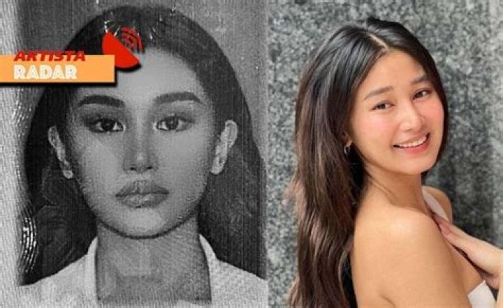 Chie Filomeno Plastic Surgery