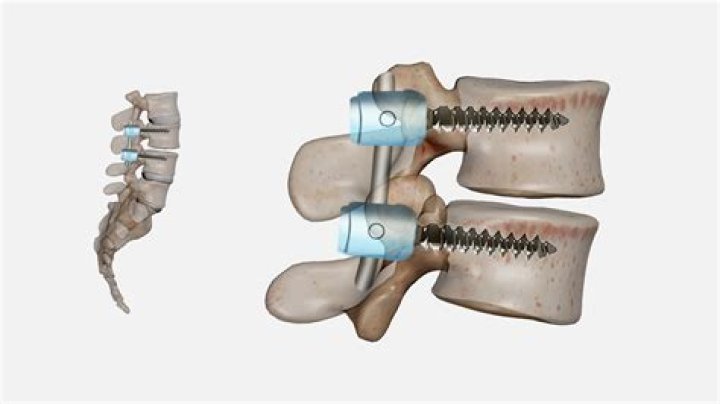 How do you remove Fusion?