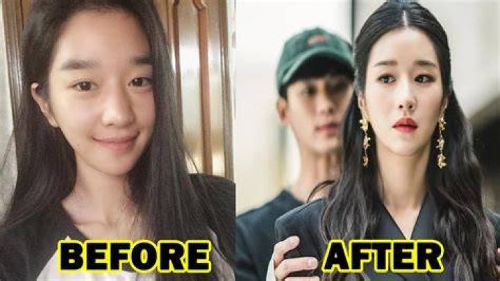 Seo Ye Ji Plastic Surgery